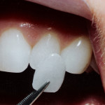 faccette-dentali-Studio-Benzi